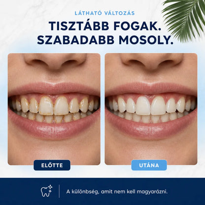 Precíziós Fogtisztító Készülék